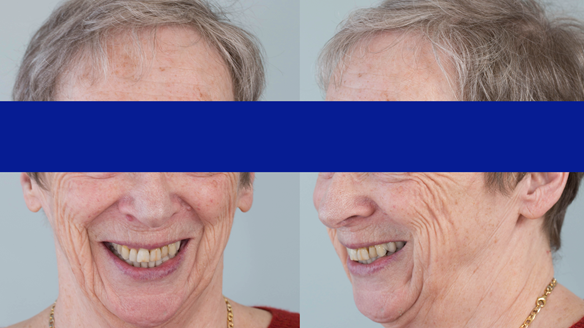 Figure 33 Finished denture mimicking the natural teeth. Schottlander Enigmalife denture teeth and Dental D clasps