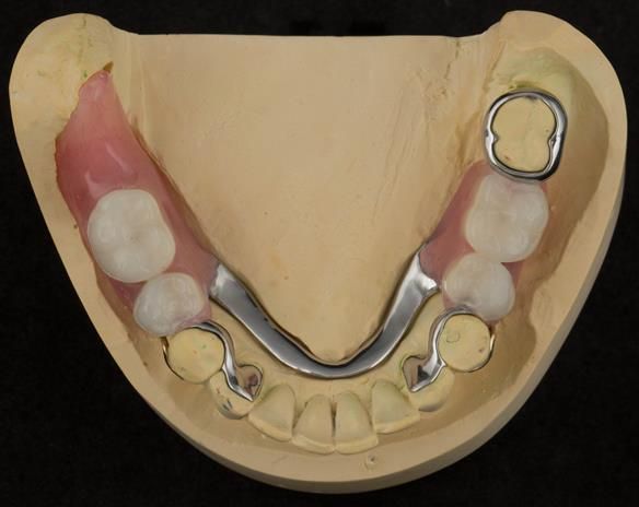 Figure 80 Finished definitive partial denture. Scandinavian design with sublingual bar - keeping the denture components 3mm away from the gingival margin