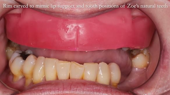 Finlay's Newsletter 58 Gasket upper partial denture for Zoe