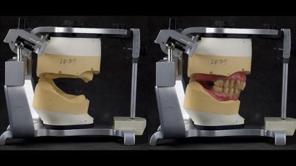 Complete denture Class II div 2 deep overbite Newsletter 39