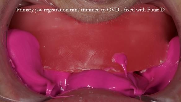 Newsletter 83: Sheila’s Complete Denture Success