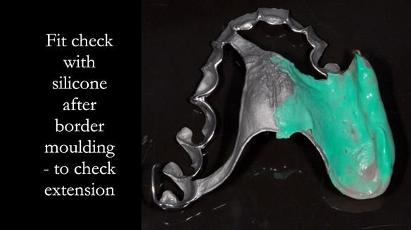 Finlay's Newsletter 64 case study - provision of a Kennedy class 2 metal based Scandinavian RPD for Ian