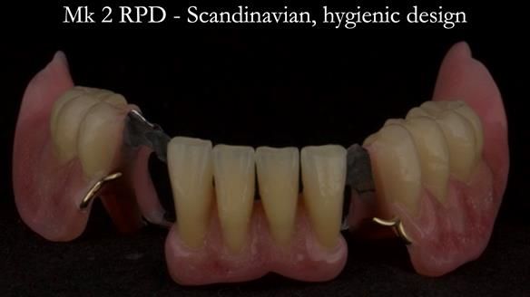 Finlay's Case Study Newsletter 40 - Immediate Mk 1 RPD to Definitive Mk 2 RPD - full protocol