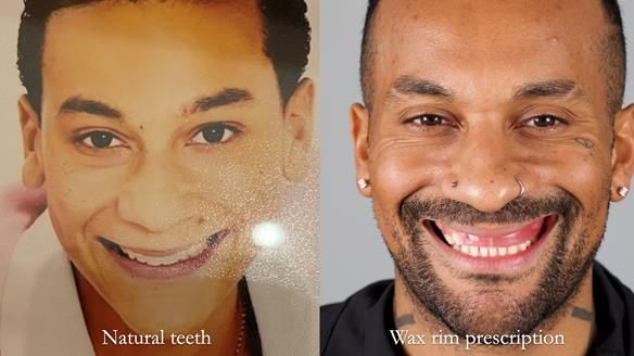 Upper metal base partial denture/occlusal stabilisation splint/obturator - full protocol