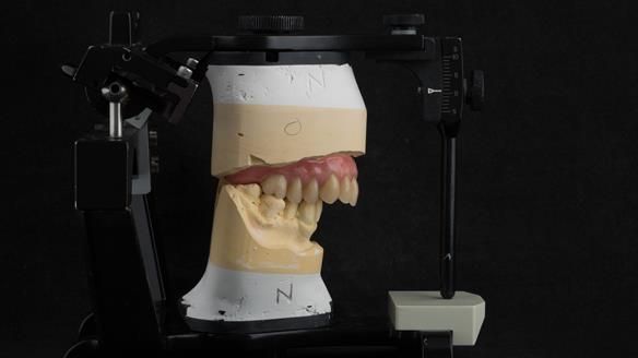Figure 24 Mounted working with Mk 1 immediate denture. 