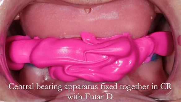 Newsletter 50 Special edition Complete Dentures FULL PROTOCOL