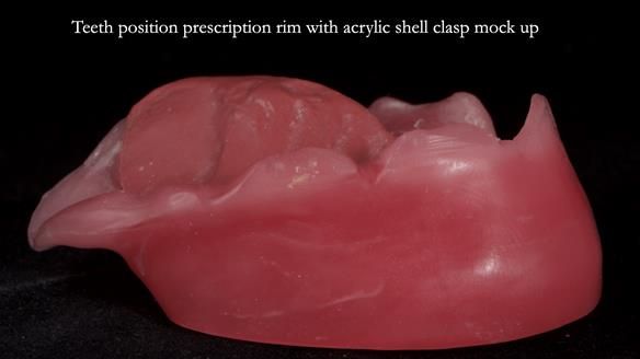 Newsletter 55 Provision of metal based partial dentures for Zephyrine with a repaired cleft lip and palate