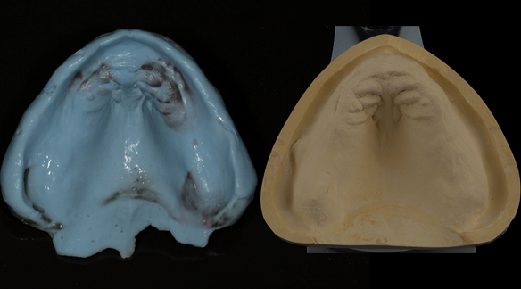 Figure 62 Definitive impression made in alginate (Blueprint) with resultant definitive cast