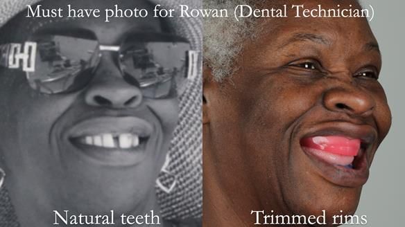 Newsletter 53 showing the making and fitting of ultra life-like dentures for Valena