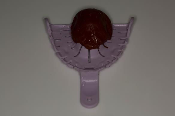 Figure 10 Modified stock tray with labial wall removed. Red cake compound placed in the palate to aid positioning of the tray