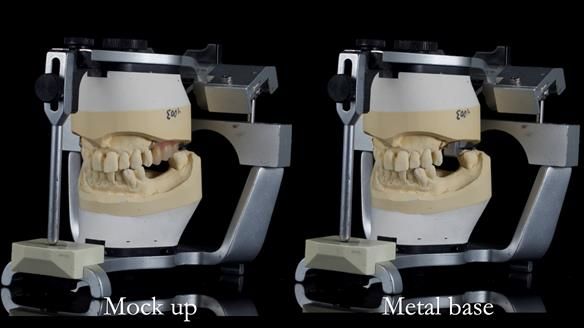 Newsletter 56 showing the making and fitting of a bilateral free end saddle upper removable partial denture (RPD) for patient with pemphigus