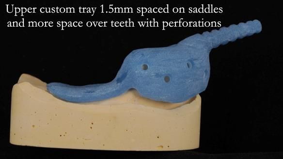Newsletter 56 showing the making and fitting of a bilateral free end saddle upper removable partial denture (RPD) for patient with pemphigus
