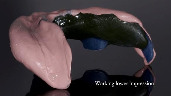 Newsletter 83: Sheila’s Complete Denture Success