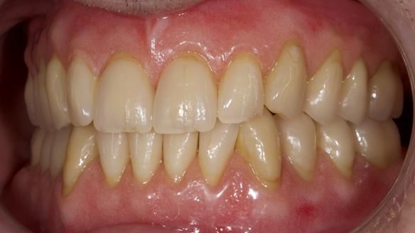 Newsletter 80 - Gordon’s dentures: the one case in 1,000 where my technique failed