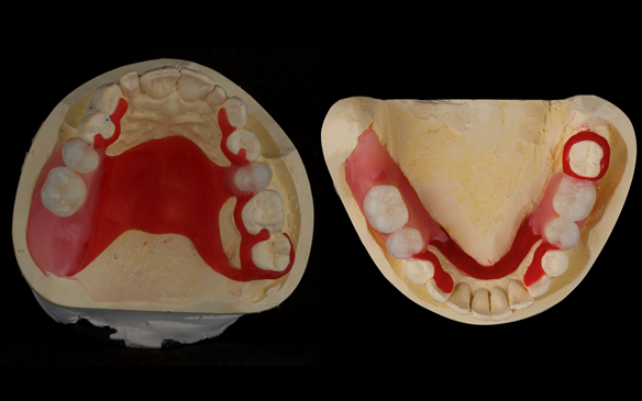 Figure 59 Teeth try in on pattern resin bases. These help to confirm the accuracy of the working casts and the amount of metal work which will be visible in the final dentures