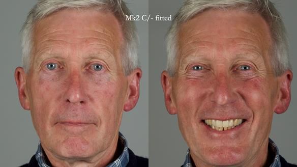 Newsletter 77: Jeremy’s case – immediate complete upper denture