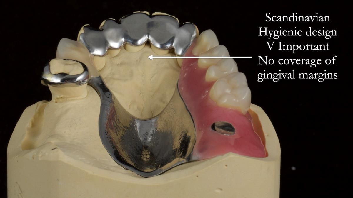 Newsletter 89 – Simon: A Challenging Kennedy Class II Division 1 Upper CoCr Partial Denture with a High Smile Line
