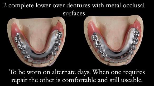Newsletter 44 - extreme removable prosthodontics – engineering a super-strong and ultra-thin over denture