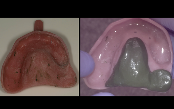 Fig 57 Greenstick compound stops are placed on the fitting surface of the custom tray to ensure repeatable positioning of the tray. Border moulded greenstick compound on the custom tray ready for the working impression in alginate.