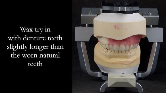 Upper metal base partial denture/occlusal stabilisation splint/obturator - full protocol