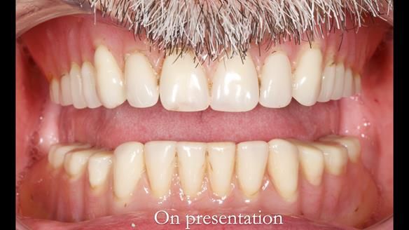 Newsletter 78: What do Clark Gable and a Locator® overdenture have in common?