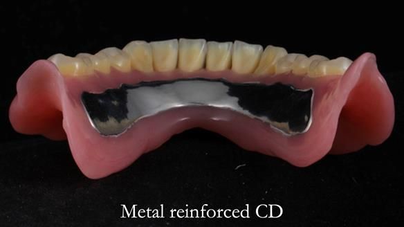 Finlay's Newsletter 62 provision of extractions and metal based complete dentures for Rafique