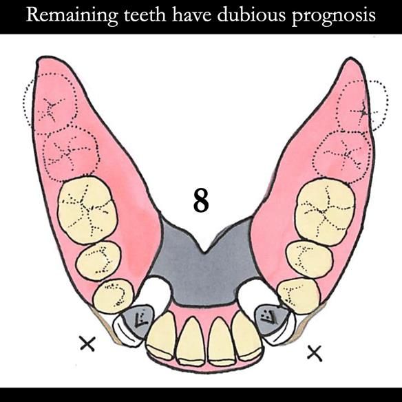 Universal Scandinavian partial denture designs