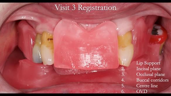 Finlay's Newsletter 59 Ultra hard partial dentures made for Gill
