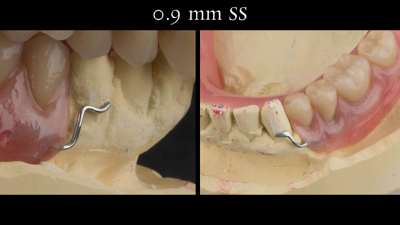 Figure 37 Mandibular immediate acrylic based partial denture with 0.9 mm wrought stainless steel clasps on LR4 and LL3