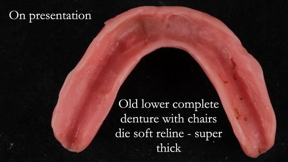 Finlay's Newsletter 62 provision of extractions and metal based complete dentures for Rafique
