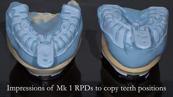 Finlay's Case Study Newsletter 40 - Immediate Mk 1 RPD to Definitive Mk 2 RPD - full protocol
