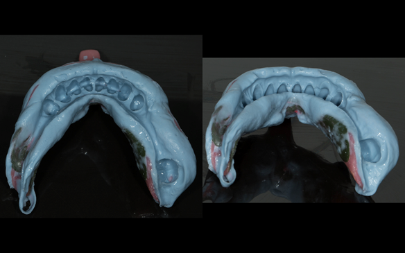 Fig 56 The finalised working impression in alginate. The patient was encouraged to exaggerate the tongue movements by “really pushing” the tongue out and moving it from “side to side” to limit excess alginate over optimally border moulded greenstick compo
