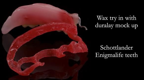 Finlay's Newsletter 61 provision of a lower unilateral free end saddle metal based partial denture for Joyce