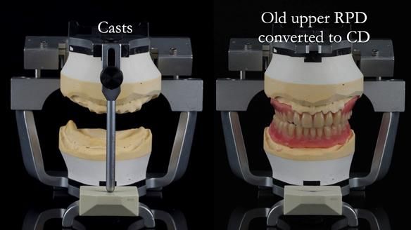Finlay's Newsletter 62 provision of extractions and metal based complete dentures for Rafique