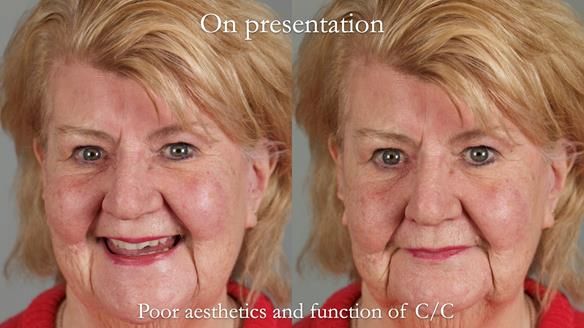 Replacing Madeline’s Complete denture FULL PROTOCOL