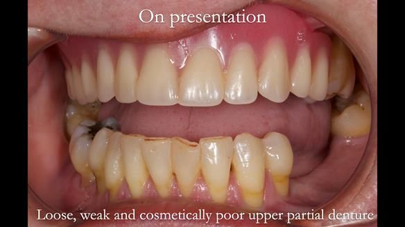 Finlay's Newsletter 58 Gasket upper partial denture for Zoe