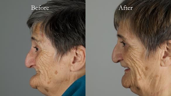 Newsletter 83: Sheila’s Complete Denture Success