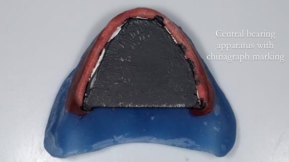 Newsletter 80 - Gordon’s dentures: the one case in 1,000 where my technique failed