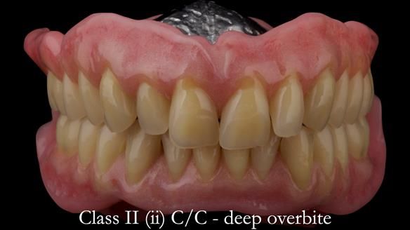 Complete denture Class II div 2 deep overbite Newsletter 39