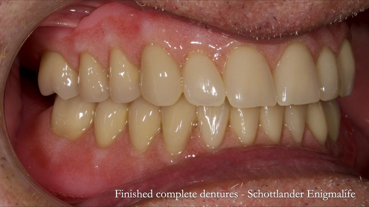 Fin’s Newsletter 88 — Complete dentures - full protocol… he rearranged his own teeth!