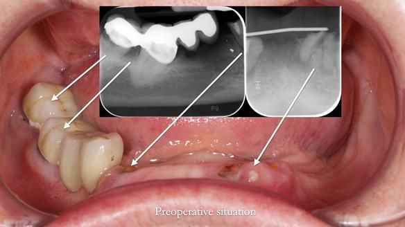 Newsletter 82 Mary - A complete upper and a one-tooth gasket denture