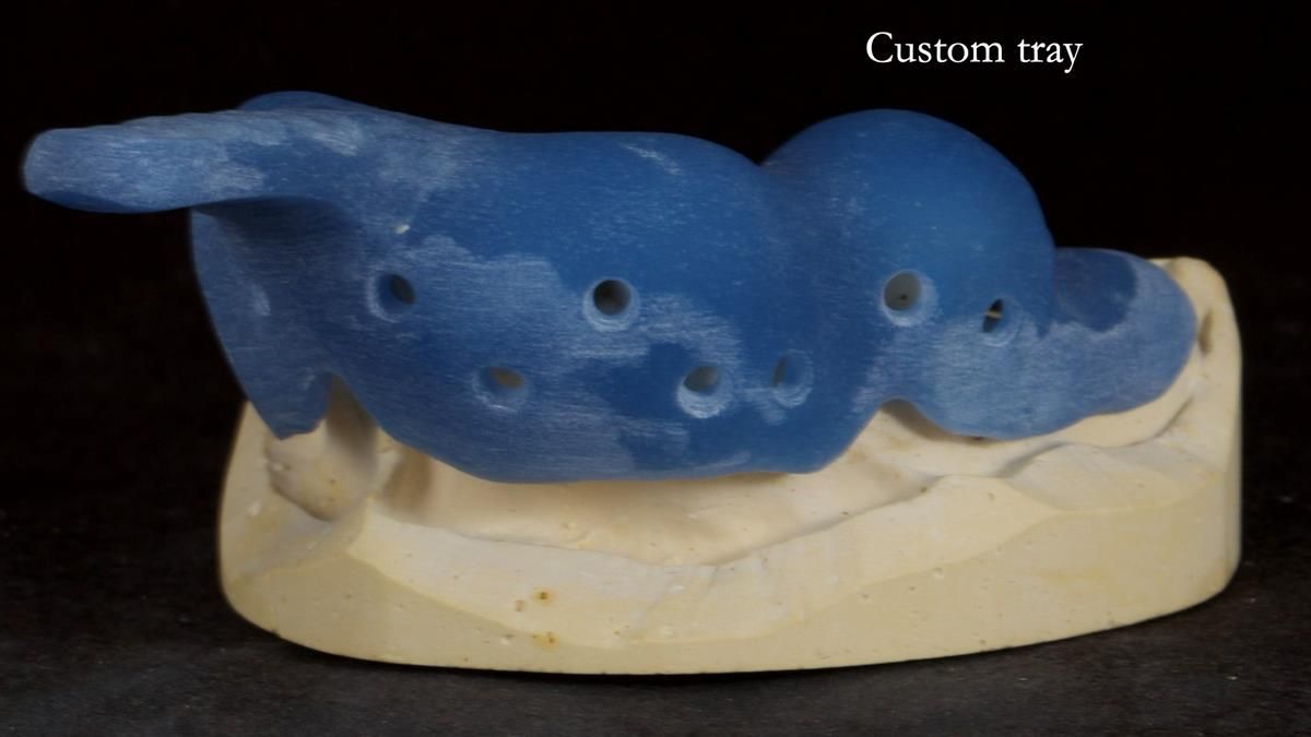 Newsletter 89 – Simon: A Challenging Kennedy Class II Division 1 Upper CoCr Partial Denture with a High Smile Line