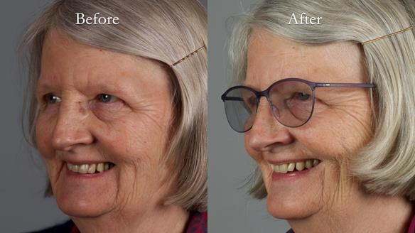 Newsletter 82 Mary - A complete upper and a one-tooth gasket denture