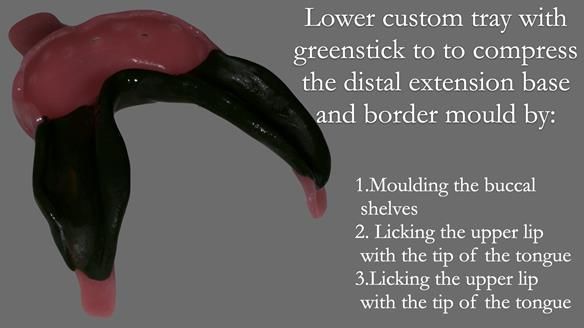 Newsletter 52 Managing Jo’s failing dentition with extractions and Mk 1/Mk 2 complete upper dentures and lower partial dentures FULL PROTOCOL