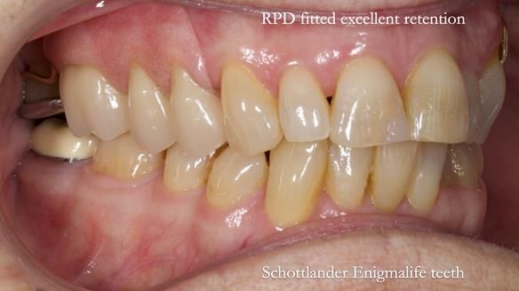 Finlay's Newsletter 60 Sylvia's upper Kennedy Class 2 Mod 1 metal based upper RPD