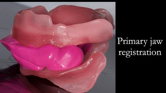 Complete denture Class II div 2 deep overbite Newsletter 39