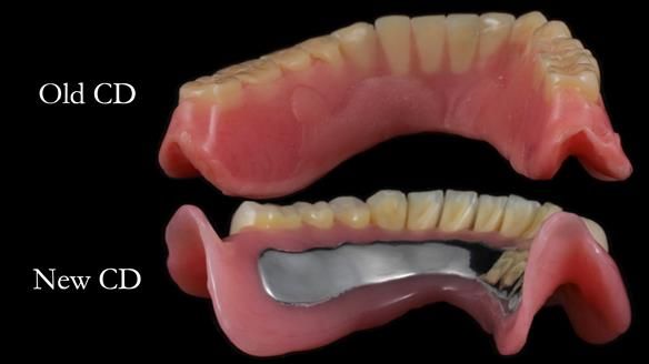 Finlay's Newsletter 62 provision of extractions and metal based complete dentures for Rafique