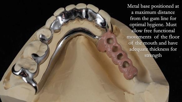 Finlay's Newsletter 61 provision of a lower unilateral free end saddle metal based partial denture for Joyce
