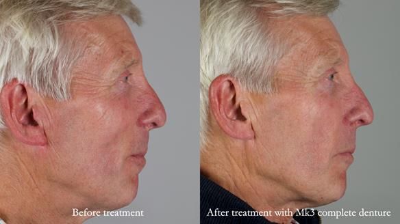Newsletter 77: Jeremy’s case – immediate complete upper denture