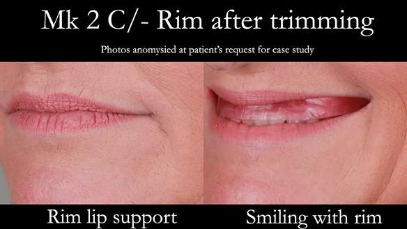 Newsletter 52 Managing Jo’s failing dentition with extractions and Mk 1/Mk 2 complete upper dentures and lower partial dentures FULL PROTOCOL